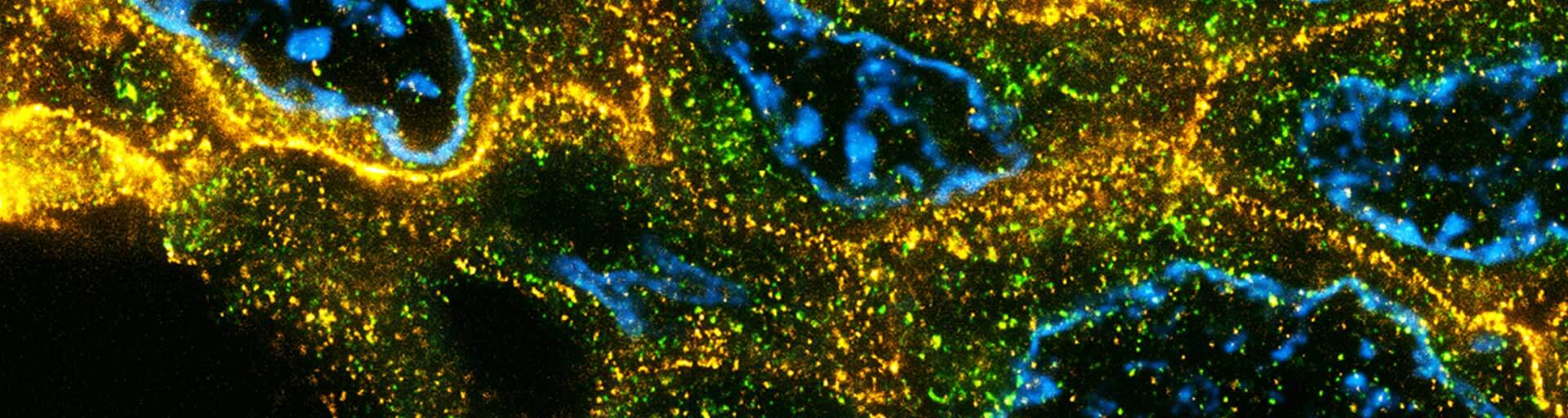 Paraffin section of breast cancer tissue labeled for a nuclear pore protein (green, abberior STAR ORANGE), Her2 (orange, STAR RED), and Hoechst (cyan).