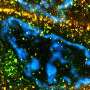 Paraffin section of breast cancer tissue labeled for a nuclear pore protein (green, abberior STAR ORANGE), Her2 (orange, STAR RED), and Hoechst (cyan).